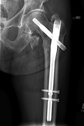 Hip Intertrochanteri Fracture IMN